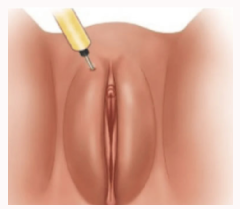Vajinal Dış Dudak Dolgusu (Hyaluronik Asit): Gaziantep’te Genç ve Dolgun Görünüm